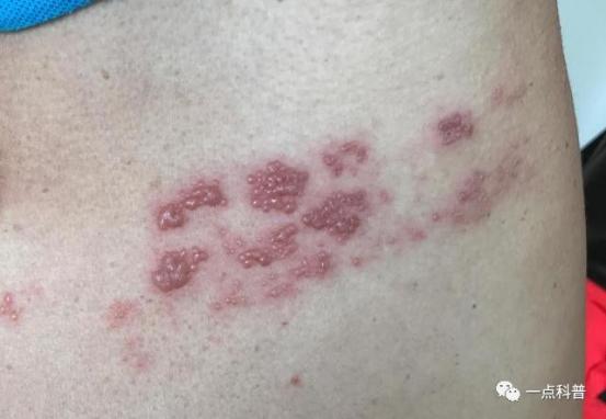 带状疱疹最好的治疗方法（女性疱疹的早期图片）
