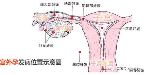 宫外孕腹部疼痛位置图片（宫外孕腹痛位置图片）