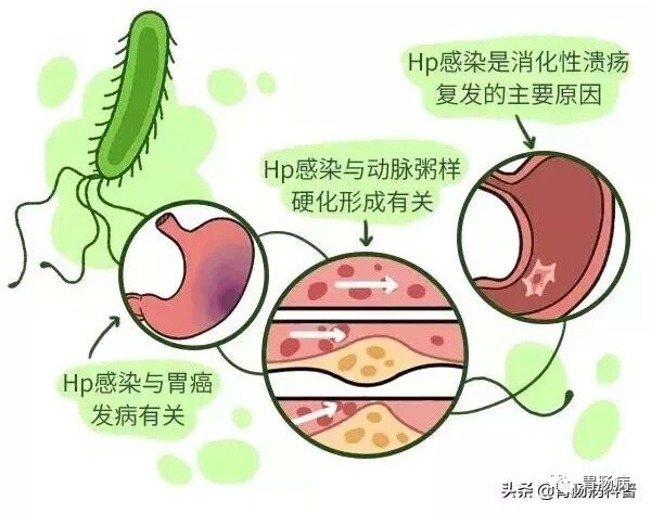 幽门螺杆菌是什么原因引起的感染（幽门螺杆菌是什么原因引起的）