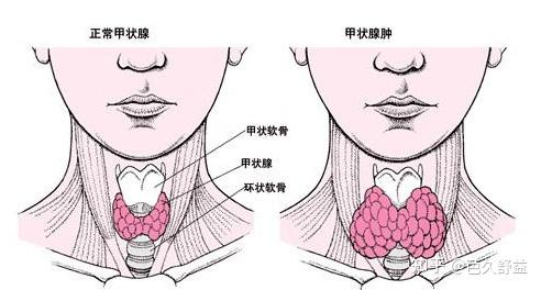 乳腺结节（甲状腺结节是什么原因造成的）