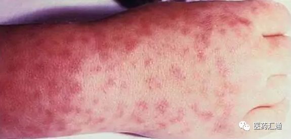 男性怎么判断自己得性疾病了（如果感染性疾病多久才会有症状）