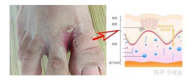 治脚气的除根方法这是我18年在贴吧里面看见的（治脚气的除根方法）