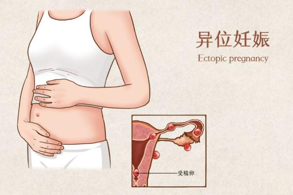 宫外怀孕的最佳处理方法重庆国宾怎么合作（宫外怀孕的最佳处理方法）