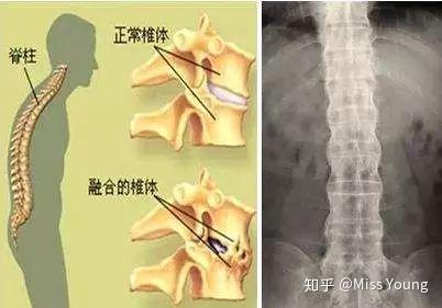 强直性脊柱炎怎么锻炼的视频（强直性脊柱炎怎么锻炼）