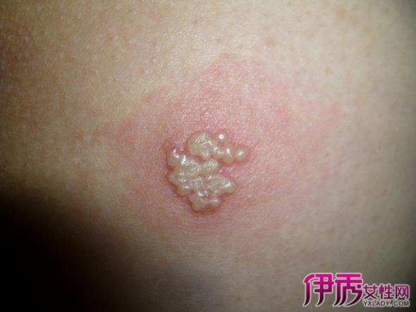 荨麻疹十大民间偏方（治疗风疹最快的方法）