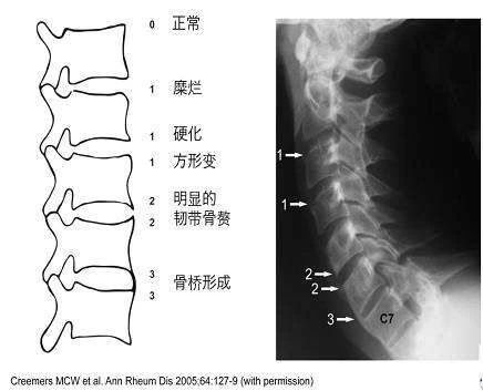 强直性脊柱炎遗传吗基因遗传吗（强直性脊柱炎遗传吗）