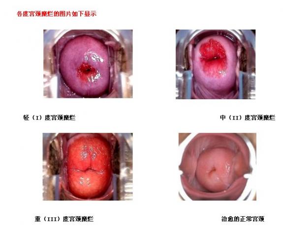轻度宫颈糜烂症状（宫颈糜烂症状）
