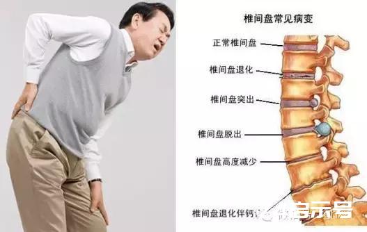 怎样判断腰肌劳损还是腰间盘突出需要住院吗（怎样判断腰肌劳损还是腰间盘