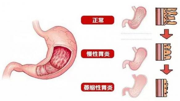 中度慢性非萎缩性胃炎是什么意思（慢性非萎缩性胃炎是什么意思）