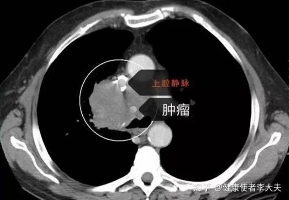 肺癌晚期死前六个月症状有哪些（肺癌晚期死前一月症状）