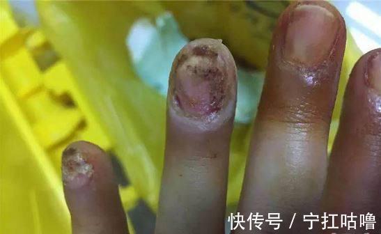 灰指甲严重会引起什么大病（灰指甲严重了有什么危害）