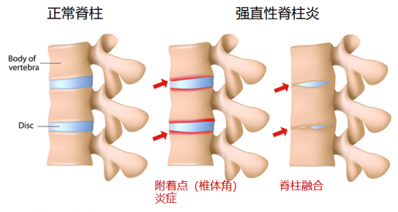强直性脊柱炎图片（强直性脊柱炎图片病因）
