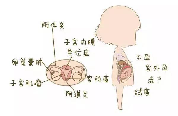女人的附件炎是怎么引起的（附件炎3个压痛点图片）