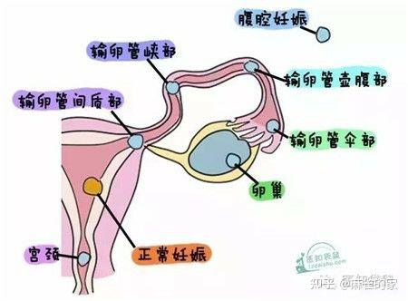 宫外怀孕是怎么形成的（宫外怀孕多少天才知道）