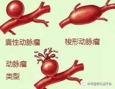 四种人是假性高血压（四种人是假性高血压180）