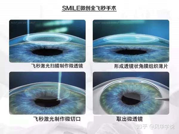眼睛激光手术大概需要多少钱（眼睛激光手术大概需要多少钱一次）