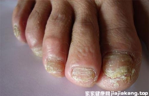 脚气真菌感染用哪些药最好（脚气真菌感染吃什么药最好）