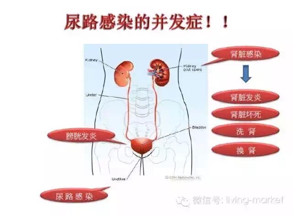 妇科尿道炎有哪些症状（细菌性阴炎怎么治彻底）