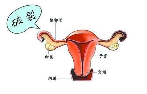 什么人容易得宫外孕（宫外孕）