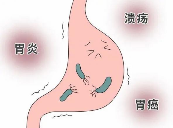 为什么不建议杀幽门螺旋杆菌（为什么说幽门螺旋杆菌不主张杀）