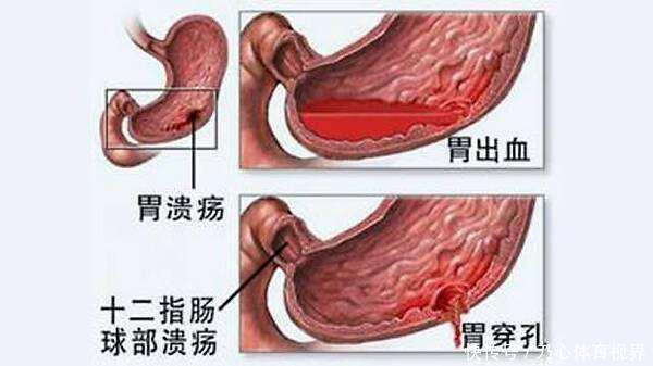 十二指肠溃疡的症状及表现（十二指肠溃疡的症状及表现图片）