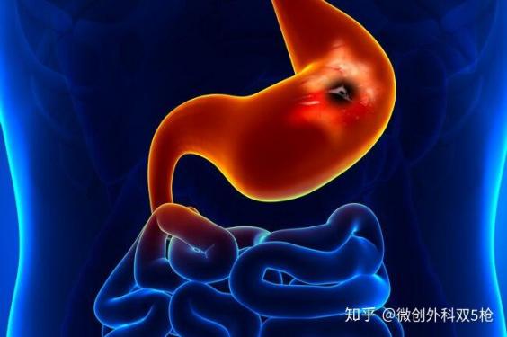 4月胃镜正常10月胃癌（4月胃镜正常10月胃癌可能性大吗）