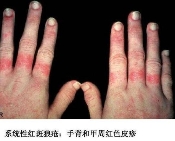 我得了红斑狼疮自愈了（我得了红斑狼疮自愈了会复发吗）