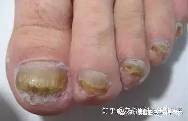 灰指甲用手摸了会传染吗（灰指甲手摸过的东西有真菌吗）