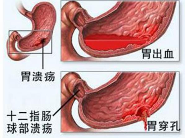 食道炎症状及表现有哪些（食道炎症状都有哪些）