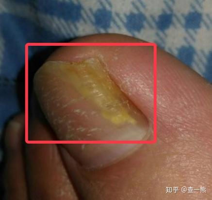指甲感染真菌的早期图片（指甲真菌感染能自愈吗）
