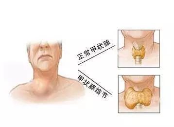 甲状腺脖子粗图片（甲状腺脖子粗图片大全）