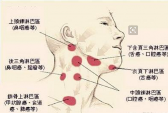 淋巴结肿大症状（淋巴结肿大症状会疼吗）