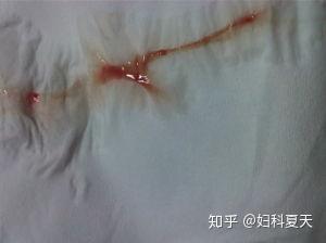 滴虫白带的症状图片（霉菌和滴虫的区别图片）