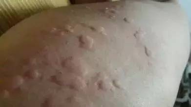 疥疮的克星（疥疮的克星是什么药）
