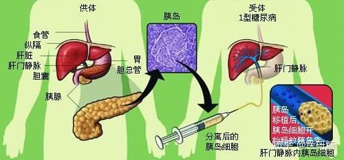 二型糖尿病能治好吗（二型糖尿病能治好吗喝什么茶好）