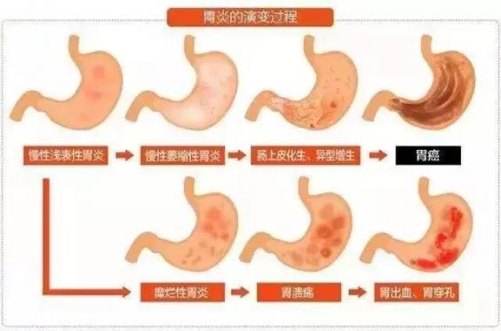 胃炎和胃癌最明显区别（胃炎和胃癌有什么区别）