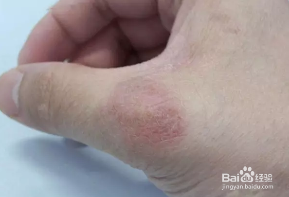 怎么判断是不是疥疮（怎么判断是不是疥疮和湿疹）