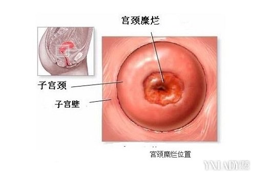 得了宫颈糜烂有哪些症状（得宫颈糜烂是什么原因引起的）