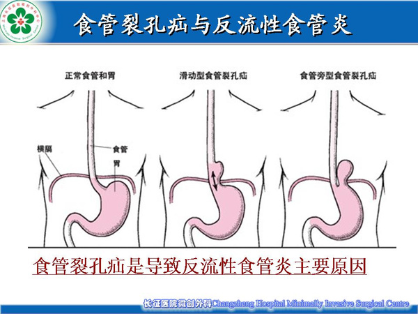 食道炎的症状及治疗（食道炎怎么治疗彻底根除）