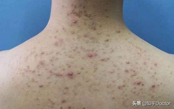 毛囊炎最怕三种东西（毛囊炎最怕三种东西视屏）