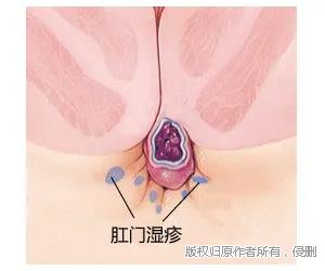 痔疮肛瘘的症状图片（痔疮肛瘘的症状图片大全）