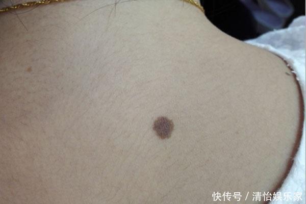 黑色素瘤一般长在哪里（黑色素瘤一般长在哪里的）