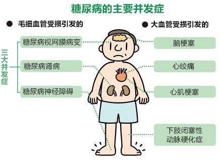 糖尿病症状的早期表现男（糖尿病的症状有哪些男）