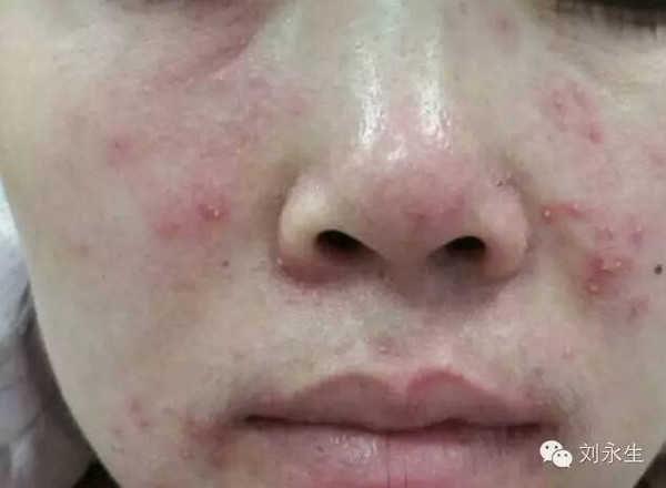 脸过敏有什么症状（怎么判断自己过敏了）