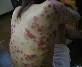 得性疾病后八大症状男（男性得了性疾病有哪些症状图片）
