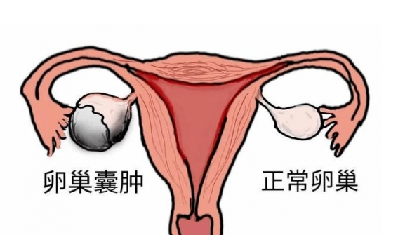 卵巢囊肿是怎么引起的（卵巢囊肿是怎么引起的怎么治疗）