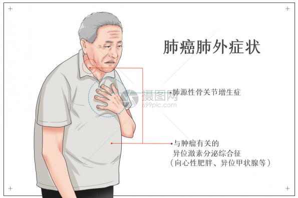 高血压症状的早期表现（高血压症状）