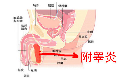 附睾炎症状图片（附睾炎的症状与位置）