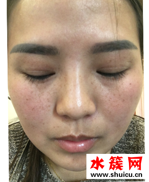 怎样祛斑？激光祛斑后悔死了