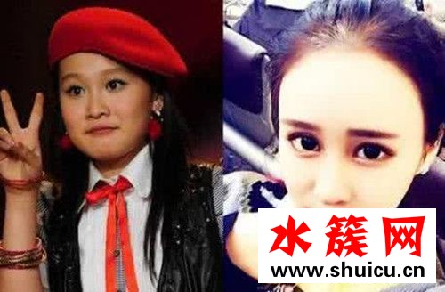 赵本山女儿球球承认整容